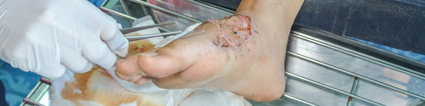 Our Services-Gangrene Infections